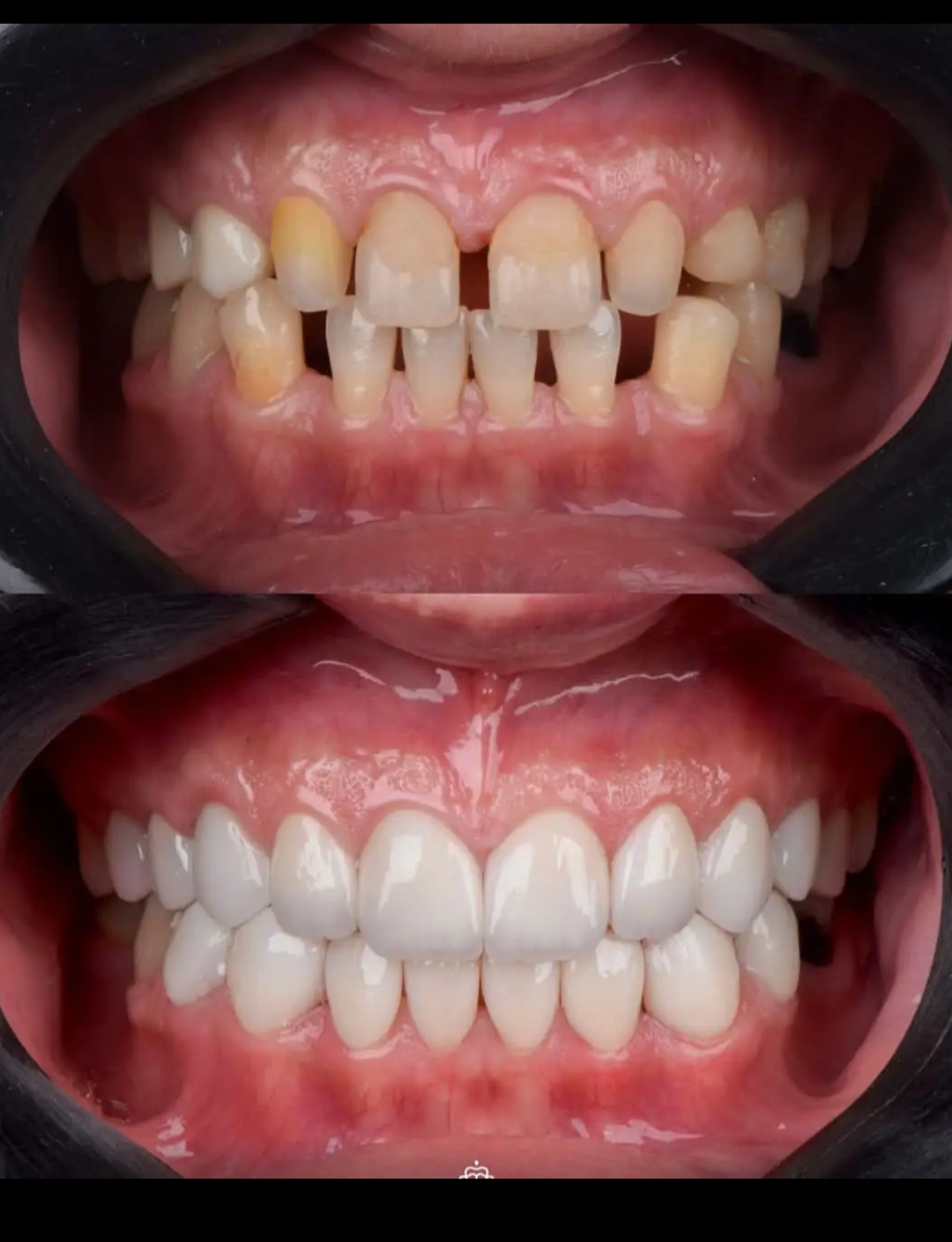 Before and after dental treatment showing improved smile