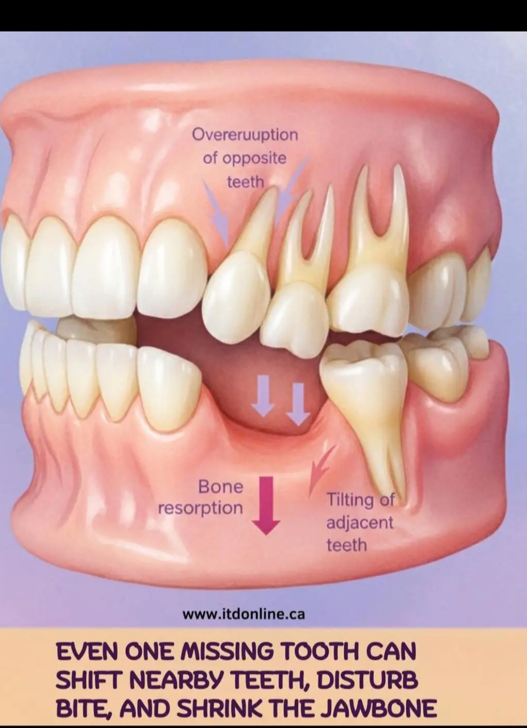 Diagram showing how a missing tooth affects nearby teeth and jawbone